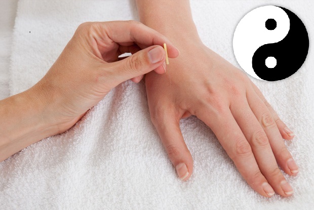 Acupuncture